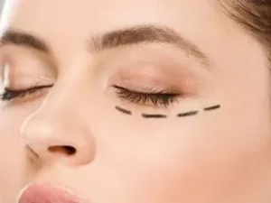 blefaroplastia-inferior