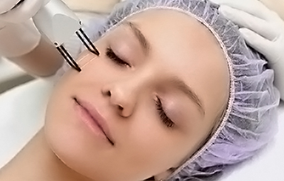 laser-co2-fracionado